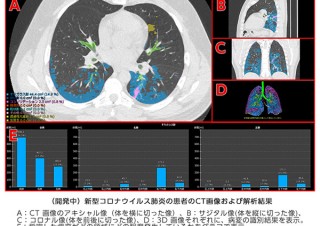 富士フイルム、AI技術を用いた新型コロナウイルス肺炎の診断支援技術の開発を開始